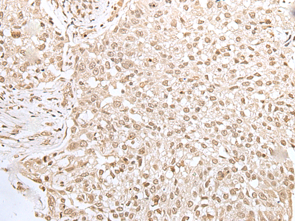 Immunohistochemistry of paraffin-embedded Human lung cancer tissue using ZKSCAN3 Polyclonal Antibody at dilution of 1:50(×200)