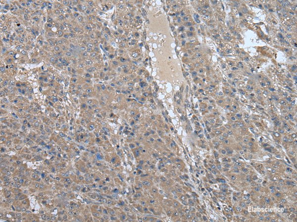 Immunohistochemistry of paraffin-embedded Human liver cancer tissue using USP32 Polyclonal Antibody at dilution of 1:75(×200)