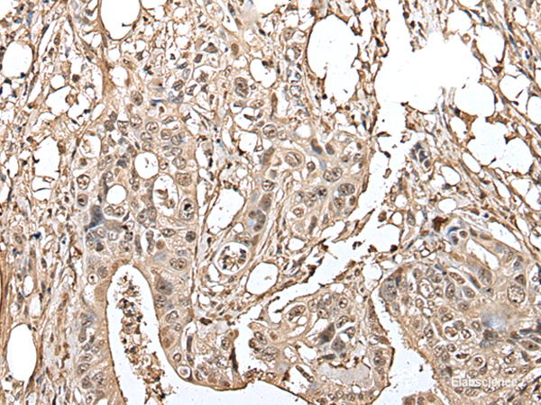 Immunohistochemistry of paraffin-embedded Human colorectal cancer tissue using UTP3 Polyclonal Antibody at dilution of 1:40(×200)
