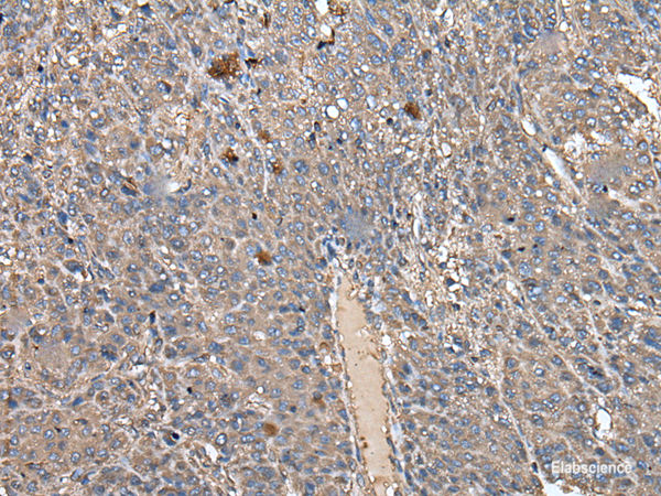 Immunohistochemistry of paraffin-embedded Human liver cancer tissue using ATAD1 Polyclonal Antibody at dilution of 1:50(×200)