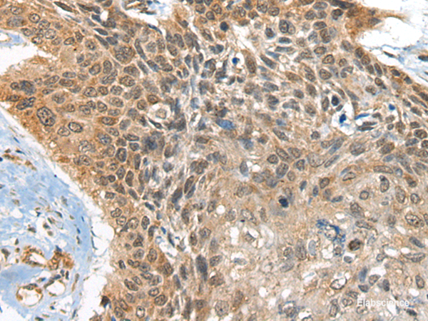 Immunohistochemistry of paraffin-embedded Human esophagus cancer tissue using BOLA1 Polyclonal Antibody at dilution of 1:35(×200)