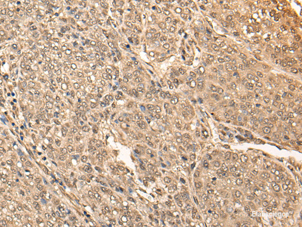 Immunohistochemistry of paraffin-embedded Human liver cancer tissue using BRF2 Polyclonal Antibody at dilution of 1:40(×200)