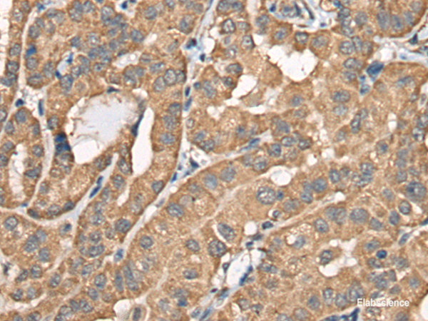Immunohistochemistry of paraffin-embedded Human thyroid cancer tissue using BCHE Polyclonal Antibody at dilution of 1:40(×200)