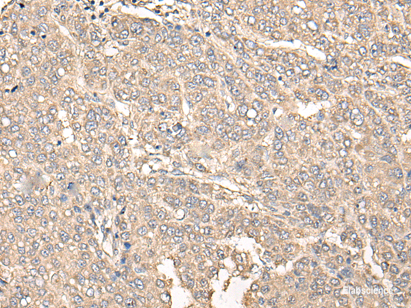 Immunohistochemistry of paraffin-embedded Human liver cancer tissue using C12orf40 Polyclonal Antibody at dilution of 1:50(×200)