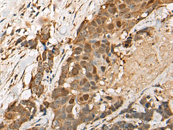 Immunohistochemistry of paraffin-embedded Human thyroid cancer tissue using HEATR9 Polyclonal Antibody at dilution of 1:110(×200)