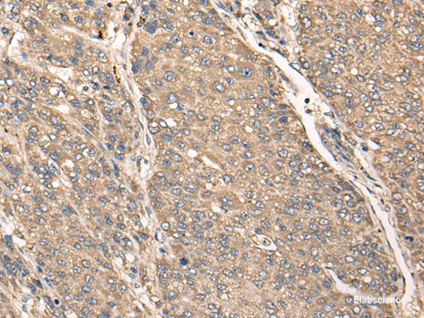 Immunohistochemistry of paraffin-embedded Human liver cancer tissue using C17orf67 Polyclonal Antibody at dilution of 1:50(×200)