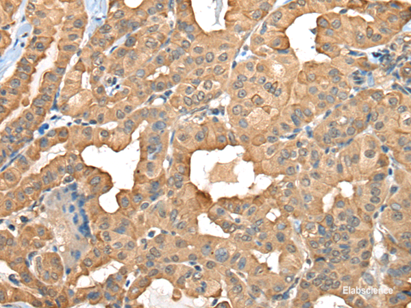 Immunohistochemistry of paraffin-embedded Human thyroid cancer tissue using C1GALT1C1 Polyclonal Antibody at dilution of 1:45(×200)