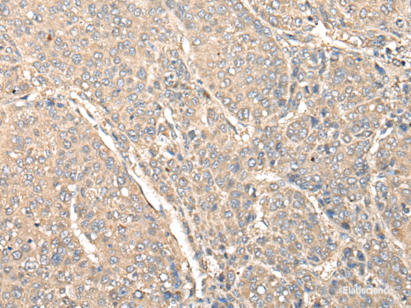 Immunohistochemistry of paraffin-embedded Human liver cancer tissue using C1orf106 Polyclonal Antibody at dilution of 1:80(×200)