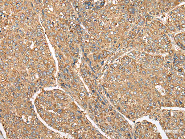 Immunohistochemistry of paraffin-embedded Human liver cancer tissue using C5AR1 Polyclonal Antibody at dilution of 1:50(×200)