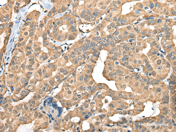Immunohistochemistry of paraffin-embedded Human thyroid cancer tissue using FAM110B Polyclonal Antibody at dilution of 1:40(×200)