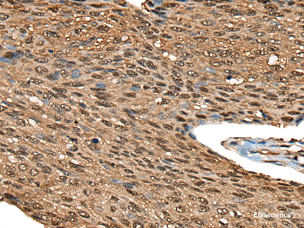 Immunohistochemistry of paraffin-embedded Human esophagus cancer tissue using CALML5 Polyclonal Antibody at dilution of 1:70(×200)