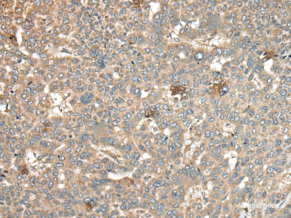 Immunohistochemistry of paraffin-embedded Human liver cancer tissue using CA11 Polyclonal Antibody at dilution of 1:45(×200)
