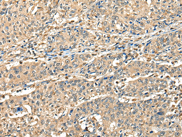 Immunohistochemistry of paraffin-embedded Human prost at e cancer tissue using CCDC112 Polyclonal Antibody at dilution of 1:45(×200)