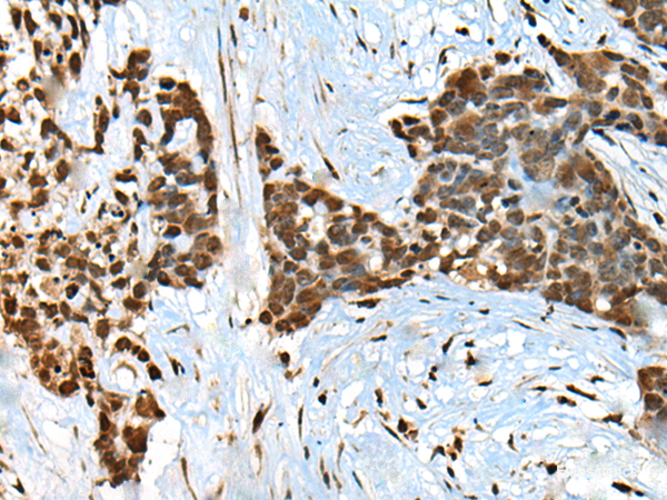 Immunohistochemistry of paraffin-embedded Human thyroid cancer tissue using CCDC12 Polyclonal Antibody at dilution of 1:60(×200)