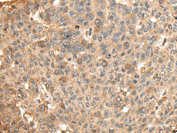 Immunohistochemistry of paraffin-embedded Human liver cancer tissue using HMMR Polyclonal Antibody at dilution of 1:45(×200)
