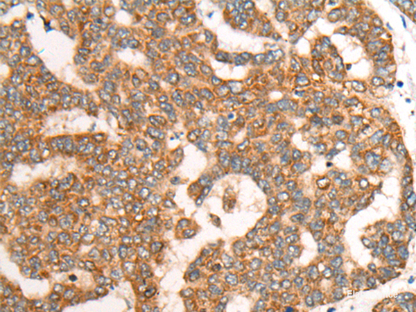 Immunohistochemistry of paraffin-embedded Human liver cancer tissue using CDON Polyclonal Antibody at dilution of 1:65(×200)