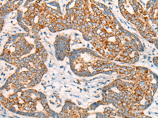 Immunohistochemistry of paraffin-embedded Human liver cancer tissue using CCT8L2 Polyclonal Antibody at dilution of 1:45(×200)