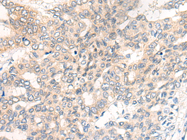 Immunohistochemistry of paraffin-embedded Human liver cancer tissue using CHRD Polyclonal Antibody at dilution of 1:40(×200)