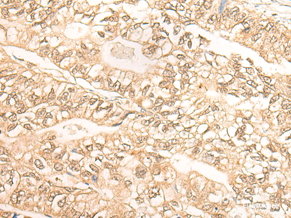 Immunohistochemistry of paraffin-embedded Human gastric cancer tissue using DMC1 Polyclonal Antibody at dilution of 1:30(×200)