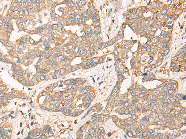 Immunohistochemistry of paraffin-embedded Human liver cancer tissue using CPNE3 Polyclonal Antibody at dilution of 1:40(×200)