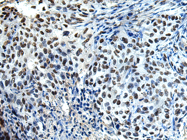 Immunohistochemistry of paraffin-embedded Human esophagus cancer tissue using DDX39A Polyclonal Antibody at dilution of 1:65(×200)
