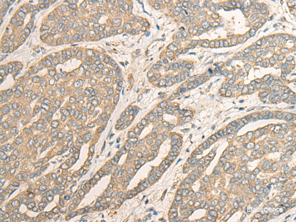 Immunohistochemistry of paraffin-embedded Human liver cancer tissue using MYOZ2 Polyclonal Antibody at dilution of 1:40(×200)