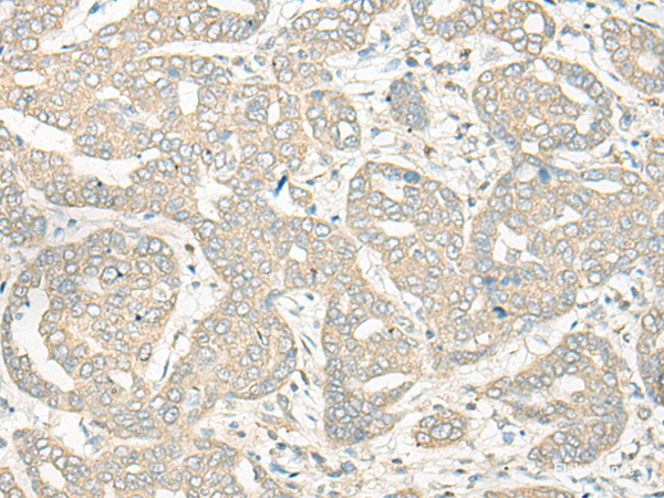 Immunohistochemistry of paraffin-embedded Human liver cancer tissue using HLA-DRB5 Polyclonal Antibody at dilution of 1:45(×200)