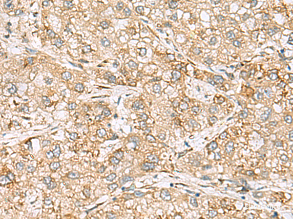 Immunohistochemistry of paraffin-embedded Human liver cancer tissue using SH3GL2 Polyclonal Antibody at dilution of 1:80(×200)