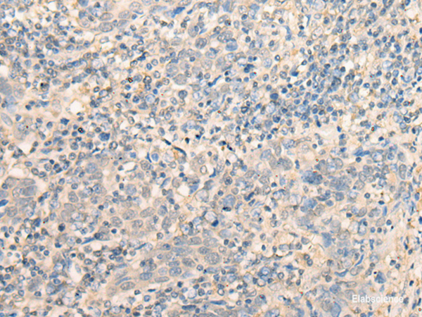 Immunohistochemistry of paraffin-embedded Human cervical cancer tissue using MR1 Polyclonal Antibody at dilution of 1:40(×200)