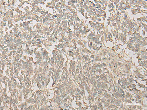 Immunohistochemistry of paraffin-embedded Human lung cancer tissue using FYTTD1 Polyclonal Antibody at dilution of 1:30(×200)