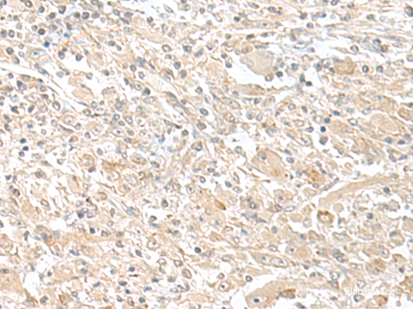 Immunohistochemistry of paraffin-embedded Human liver cancer tissue using SMS Polyclonal Antibody at dilution of 1:50(×200)