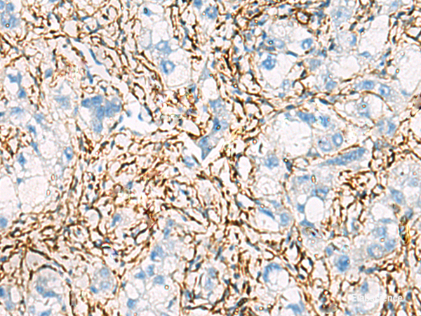 Immunohistochemistry of paraffin-embedded Human liver cancer tissue using ACTC1 Polyclonal Antibody at dilution of 1:55(×200)