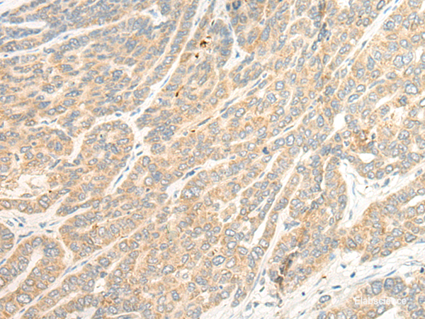 Immunohistochemistry of paraffin-embedded Human liver cancer tissue using TTC4 Polyclonal Antibody at dilution of 1:45(×200)