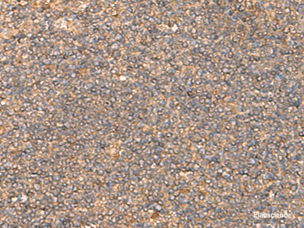 Immunohistochemistry of paraffin-embedded Human tonsil tissue using DNAJC14 Polyclonal Antibody at dilution of 1:55(×200)
