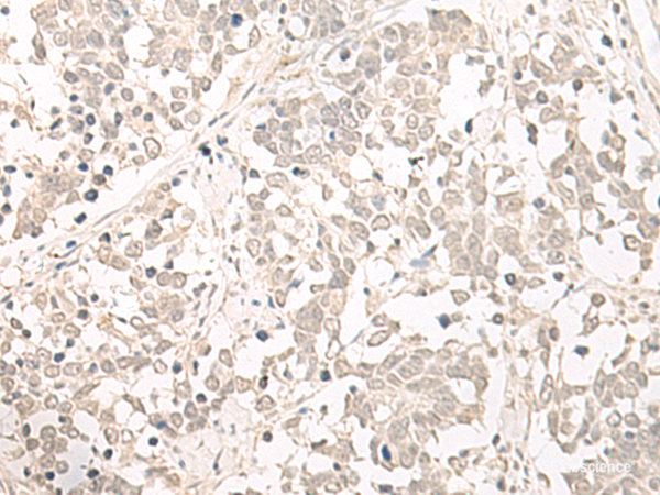 Immunohistochemistry of paraffin-embedded Human lung cancer tissue using OLA1 Polyclonal Antibody at dilution of 1:55(×200)