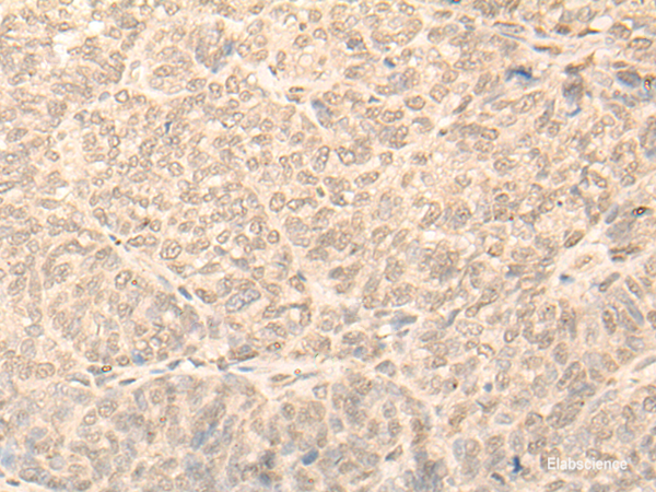 Immunohistochemistry of paraffin-embedded Human ovarian cancer tissue using NARF Polyclonal Antibody at dilution of 1:45(×200)