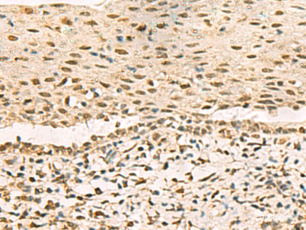 Immunohistochemistry of paraffin-embedded Human cervical cancer tissue using GRWD1 Polyclonal Antibody at dilution of 1:90(×200)