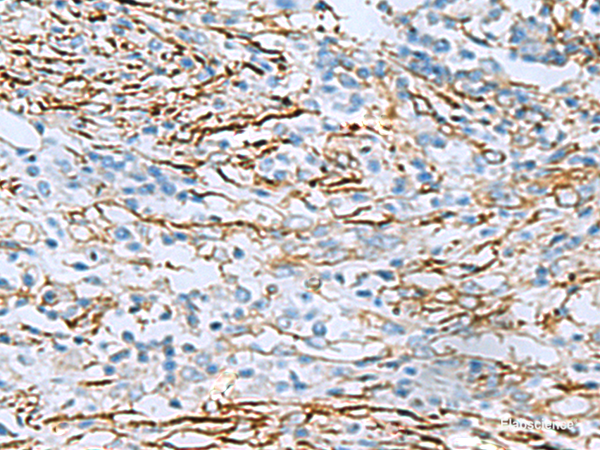 Immunohistochemistry of paraffin-embedded Human breast cancer tissue using DPYSL3 Polyclonal Antibody at dilution of 1:55(×200)