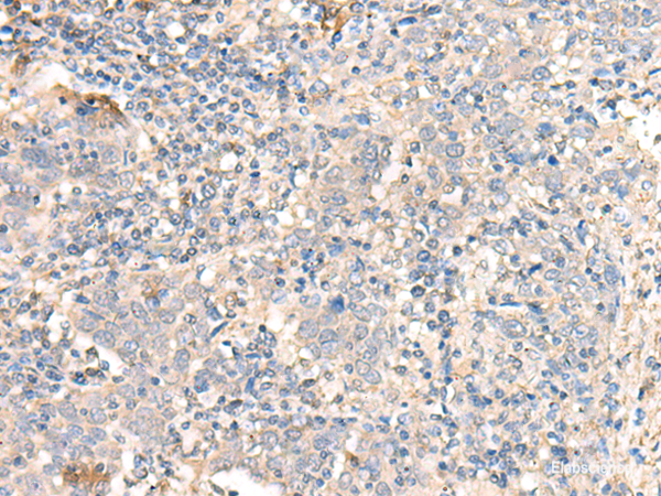 Immunohistochemistry of paraffin-embedded Human cervical cancer tissue using PARS2 Polyclonal Antibody at dilution of 1:30(×200)