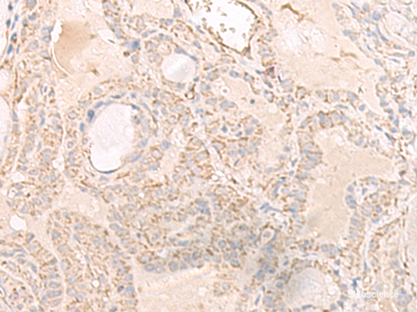 Immunohistochemistry of paraffin-embedded Human thyroid cancer tissue using IGHA1 Polyclonal Antibody at dilution of 1:65(×200)