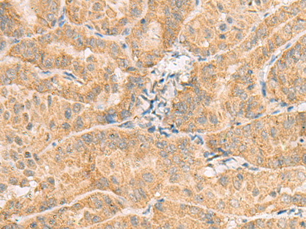 Immunohistochemistry of paraffin-embedded Human thyroid cancer tissue using NCOA4 Polyclonal Antibody at dilution of 1:130(×200)