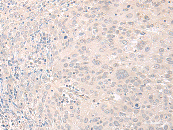 Immunohistochemistry of paraffin-embedded Human cervical cancer tissue using FOXRED2 Polyclonal Antibody at dilution of 1:35(×200)
