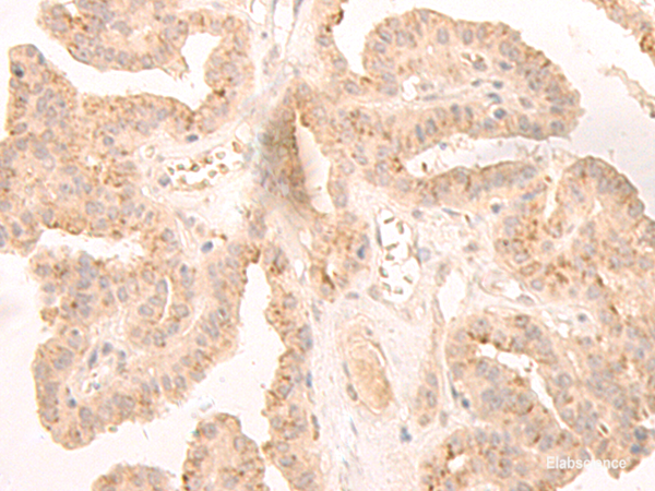 Immunohistochemistry of paraffin-embedded Human thyroid cancer tissue using LCMT2 Polyclonal Antibody at dilution of 1:45(×200)