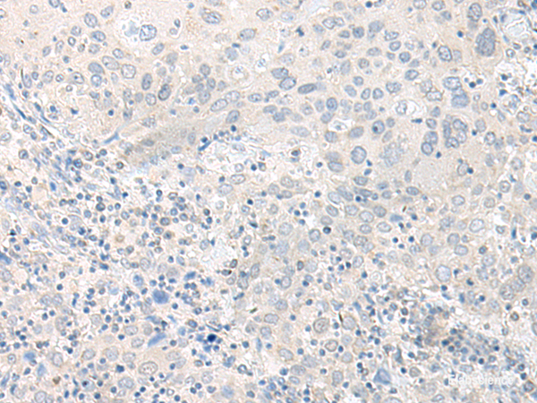 Immunohistochemistry of paraffin-embedded Human cervical cancer tissue using TIMM8A Polyclonal Antibody at dilution of 1:50(×200)