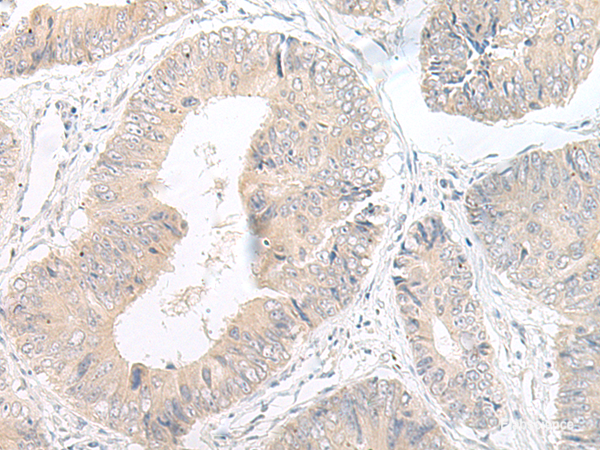 Immunohistochemistry of paraffin-embedded Human colorectal cancer tissue using LYRM2 Polyclonal Antibody at dilution of 1:50(×200)