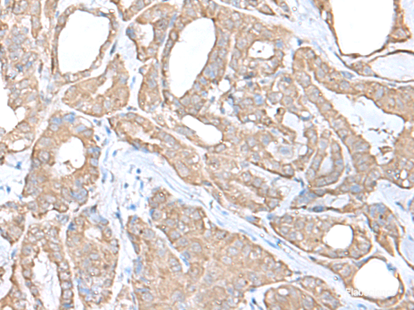 Immunohistochemistry of paraffin-embedded Human thyroid cancer tissue using C9orf116 Polyclonal Antibody at dilution of 1:55(×200)