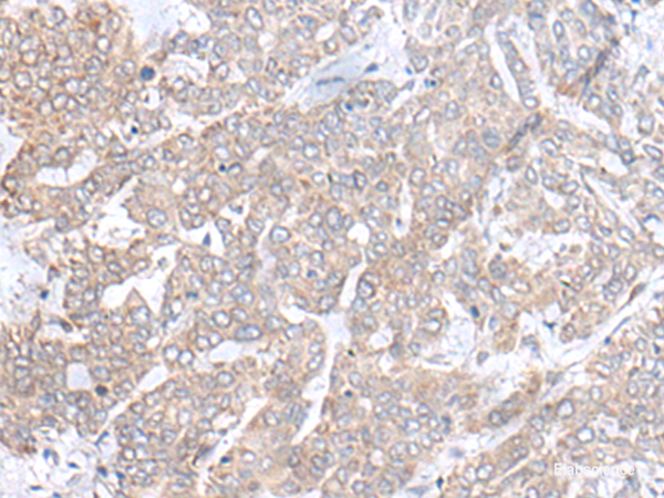 Immunohistochemistry of paraffin-embedded Human liver cancer tissue using PLGLB2 Polyclonal Antibody at dilution of 1:65(×200)