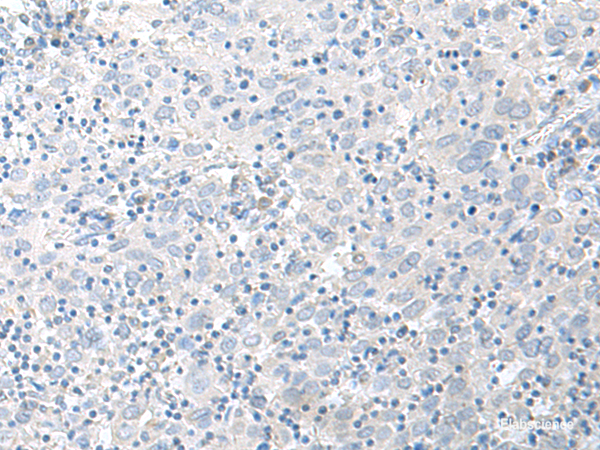 Immunohistochemistry of paraffin-embedded Human cervical cancer tissue using STAU2 Polyclonal Antibody at dilution of 1:45(×200)