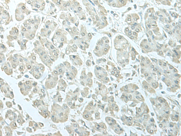 Immunohistochemistry of paraffin-embedded Human gastric cancer tissue using C8orf4 Polyclonal Antibody at dilution of 1:55(×200)