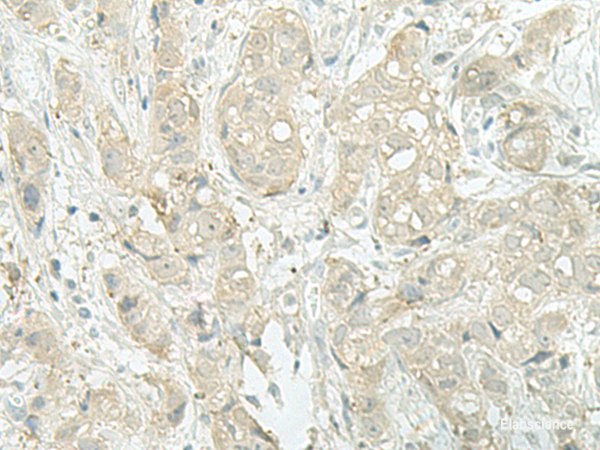 Immunohistochemistry of paraffin-embedded Human breast cancer tissue using MIEN1 Polyclonal Antibody at dilution of 1:45(×200)